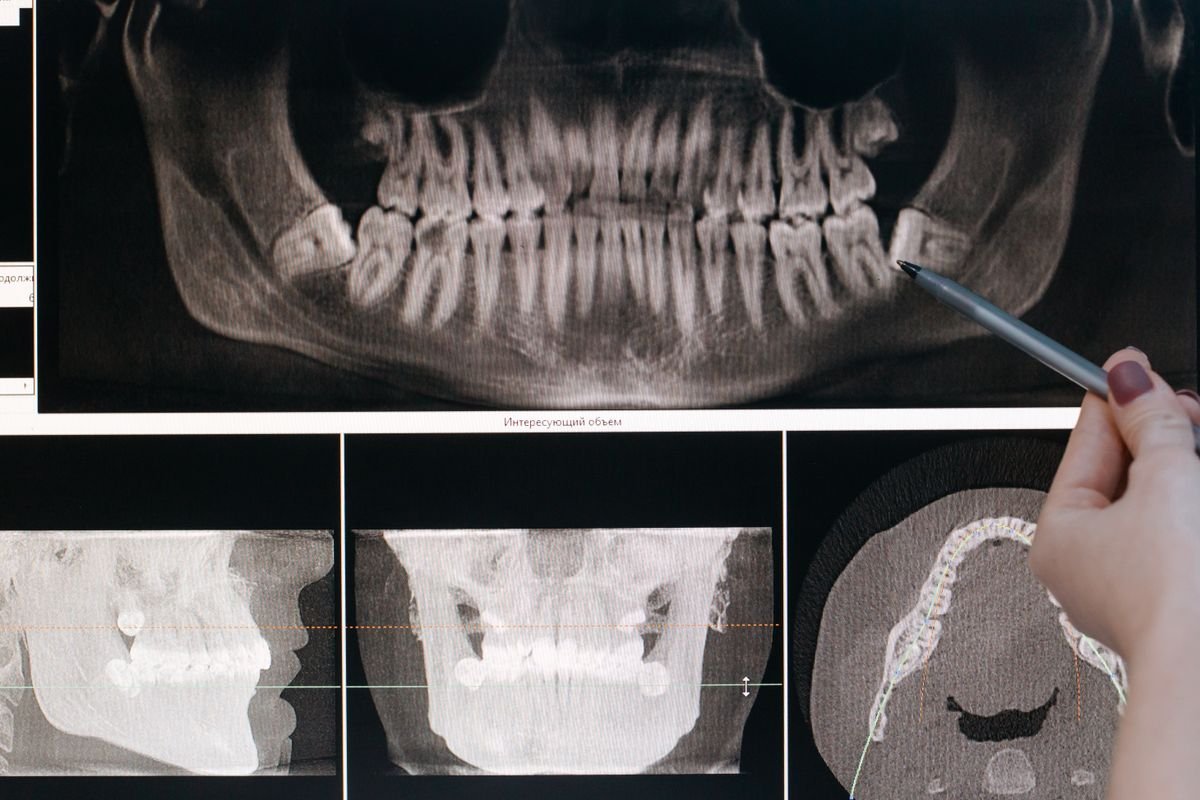 Dental X-ray showing teeth and jawbone structure used to check for bone loss
